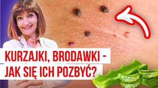 🚩 Kurzajki Brodawki  jak się ich pozbyć 🚩 13 domowych sposobów by znikły bez śladu 🚩 [upl. by Letnohc633]