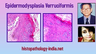 Pathology of Epidermodysplasia Verruciformis  Dr Sampurna Roy MD  dermpath dermatopathology [upl. by Melodee]