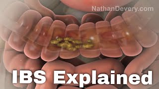 What is irritable bowel syndrome IBS explained [upl. by Thin]