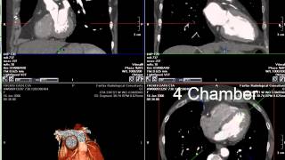 Coronary CT Angiography RCA Stenosis [upl. by Anev458]