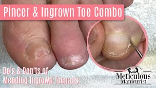 How To Pedicure Dos amp Donts on Ingrown amp Pincer Toenail [upl. by Ibib734]