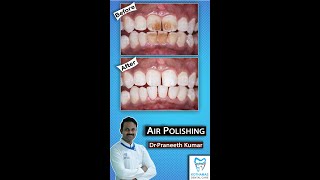 How Teeth Are Cleaned At The Dentist Painlessly  Contactless Air Polishing Technology Shorts [upl. by Anoirb]