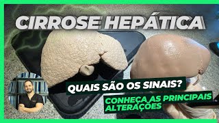 Cirrose Hepática Anatomia Sintomas e Tratamento com Demonstração Prática [upl. by Yorled]