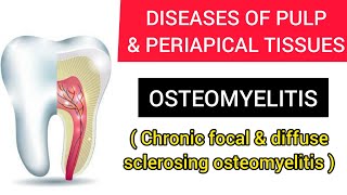 OSTEOMYELITIS CHRONIC FOCAL AND DIFFUSE SCLEROSING OSTEOMYELITIS [upl. by Erv]