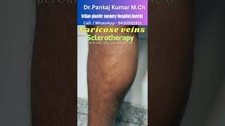 15824 Foam Sclerotherapy treatment for varicose veins Varicose veins treatment before SSC GD [upl. by Nodnalb]