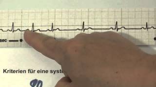 EKG für Pflege Teil 13  atemabhängige Sinusarrhythmie interpretieren [upl. by Anirehtak]