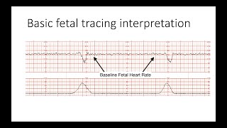 Interpreting Intrapartal fetal heart rate tracings [upl. by Marilla]