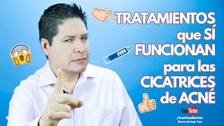 TRATAMIENTOS QUE SÍ FUNCIONAN EN CICATRICES DE ACNÉ [upl. by Harrietta]