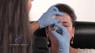 Botulinum Toxin  Injection Technique [upl. by Sharlene33]