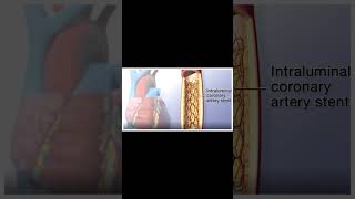 Angioplasty Procedure Animation VideoWhat are the steps of angioplasty [upl. by Tnilc]