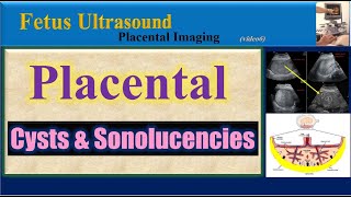 Fetus Ultrasound Placental Cysts amp Sonolucencies [upl. by Cornelle]