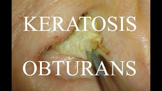 KERATOSIS OBTURANS COMPLETE IMPACTION  4KHD [upl. by Gabie]