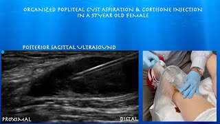 Ultrasound Guided Complex Popliteal Cyst Aspiration and Cortisone Injection by probeultrasound [upl. by Rebmit]