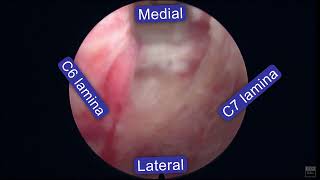 Fully endoscopic cervical discectomy posterior  C6C7 Disc Herniation left 7 radiculópathy [upl. by Utir383]