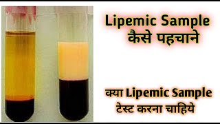 Lipemic blood sample  Lipemic  Lipemic serum [upl. by Kristan748]