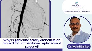 Why is genicular artery embolization more difficult than knee replacement surgery [upl. by Erika]