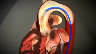 Transcatheter Aortic Valve Replacement TAVR animation [upl. by Pillow963]