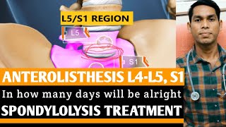 Anterolisthesis spondylolisthesis L4 L5 S1 exercise treatment l5s1 chiropractic adjustment disc [upl. by Asirem]