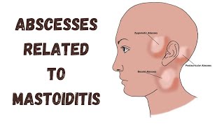 Abscesses related to mastoiditis  Complications of otitis media [upl. by Ailimat]