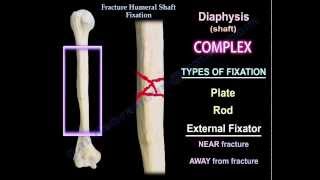 Humeral Shaft fracture Fixation  Everything You Need To Know  Dr Nabil Ebraheim [upl. by Mozelle]