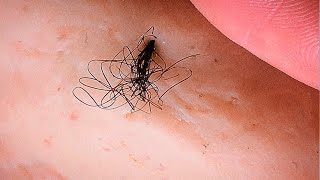 Removal of ingrown hair [upl. by Chrissie]