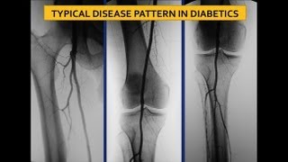 UCSF Vascular Surgery Symposium  Screening for Ischemia in the Diabetic Foot [upl. by Glynnis]