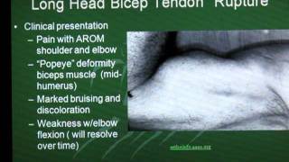 Long Head Biceps Tendon Rupture [upl. by Freyah512]