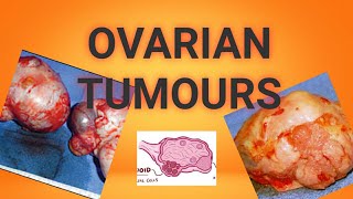 Various Ovarian tumours Dermoid Cyst  Krukenberg Tumour etc [upl. by Ireg]