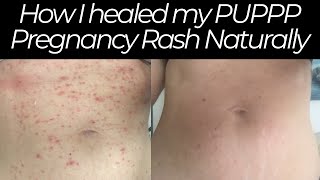 How I Healed my PUPPP Pregnancy Rash Naturally [upl. by Anura]