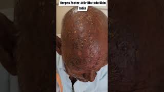 Herpes Zoster Dr Bhutada Skin India [upl. by Nwahs288]