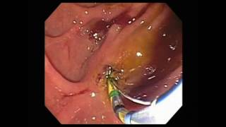 Free Hand Needle Knife Sphincterotomy  Mohamed Othman MD [upl. by Leur987]