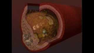 Chelation Therapy Video [upl. by Liscomb]