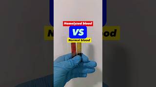 Hemolyzed blood vs Normal blood serum sample medtech medtechstudent laboratory bloodserum blood [upl. by Avner]