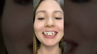 Agenesia dental dientes dentista tips parati viral fyp shorts shortvideo fypシ [upl. by Rehpotsirh]