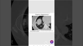 Popcorn calcificationbreast radiologyinicet neetpg [upl. by Eedebez]