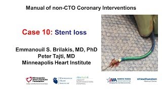 Case 10 PCI Manual  Stent loss [upl. by Ynatterb]