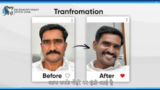 Full Mouth Rehabilitation Transformation  Dr Thakur’s Nexgen Clinic Shrirampur [upl. by Garwin]