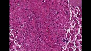 Histopathology Liver Histoplasmosis [upl. by Hakaber]