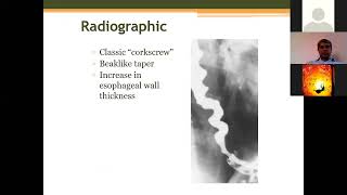 Why Cant I Swallow The Science Behind Dysphagia [upl. by Jaynes]