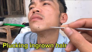 I think Plucking ingrown hair but sure hairy mole formr Luc ASMR [upl. by Asirret]