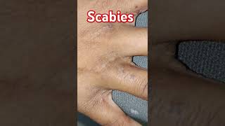 scabies skincare fungaldisease skin diseases [upl. by Dazhahs]