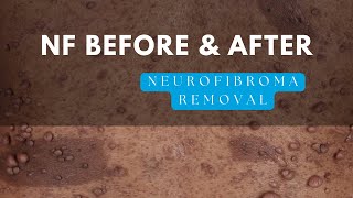 Before and After of NF1 Surgery for Tumor Removal [upl. by Karney]