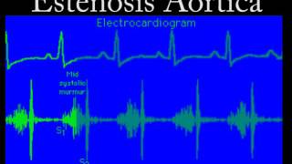 Soplo de la Estenosis Aórtica [upl. by Ardnaz931]