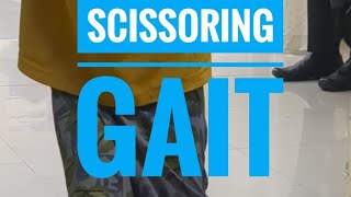 Scissoring Gait  Spastic Paraplegia  Cerebral palsy CP  medicine neurology [upl. by Eeraj]