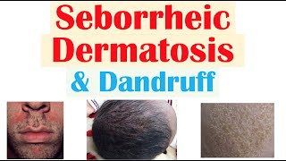 Seborrheic Dermatitis Dandruff and Cradle Cap Causes Risk Factors Symptoms Diagnosis Treatment [upl. by Jacquenetta516]