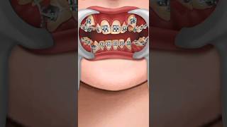 ASMR Braces Process animation video 2024shorts [upl. by Yrroc]