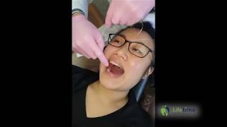 How To Replace an Orthodontic Separator [upl. by Su]