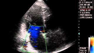 Echocardiography diagnosis eccentric mitral regurgitation [upl. by Ioj912]