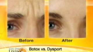 BOTOX VS DYSPORT [upl. by Aecila]