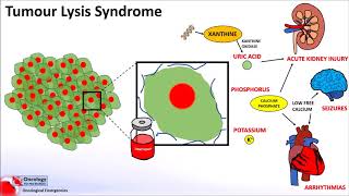 Tumour Lysis Syndrome [upl. by Doherty]